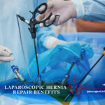 Laparoscopic Hernia Repair Benefits