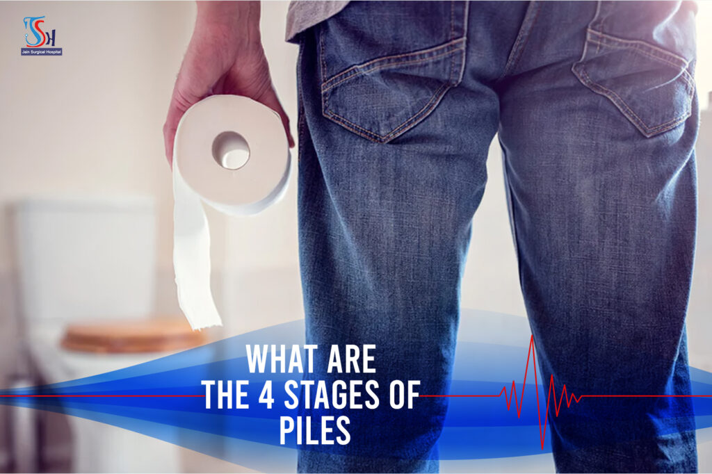 What Are The 4 Stages Of Piles?  